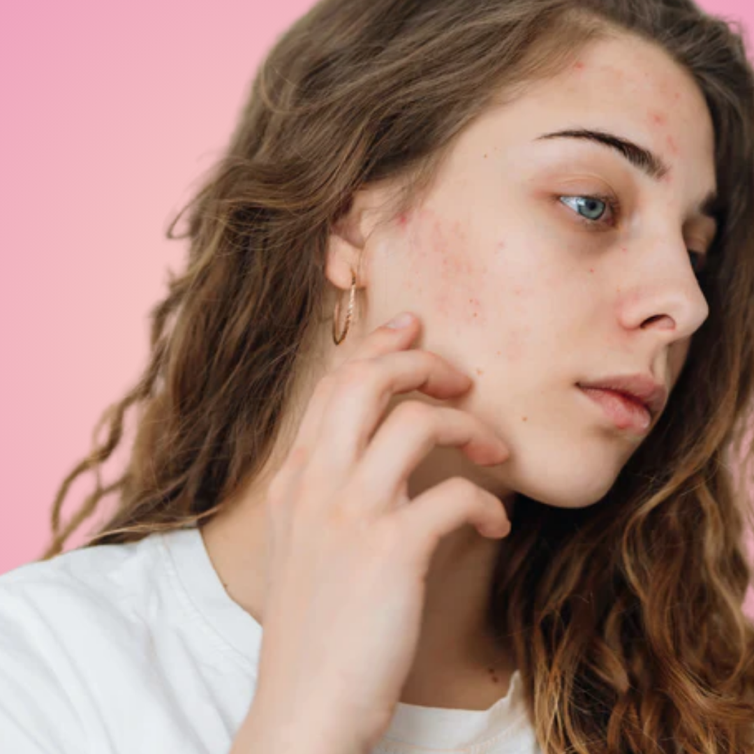 Sensibilité et rougeurs